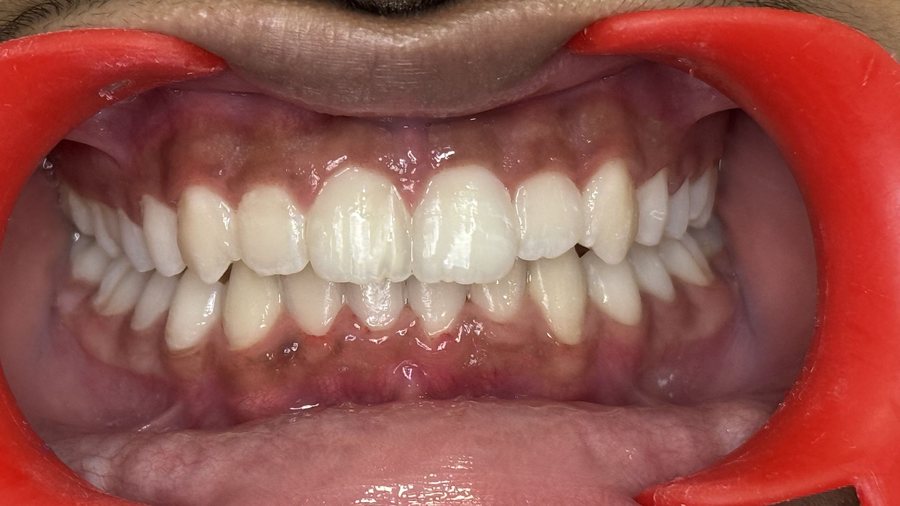 Clear Aligners – Crowding - After