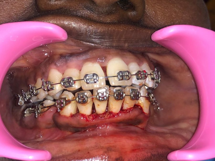 Gingival Enlargement - After
