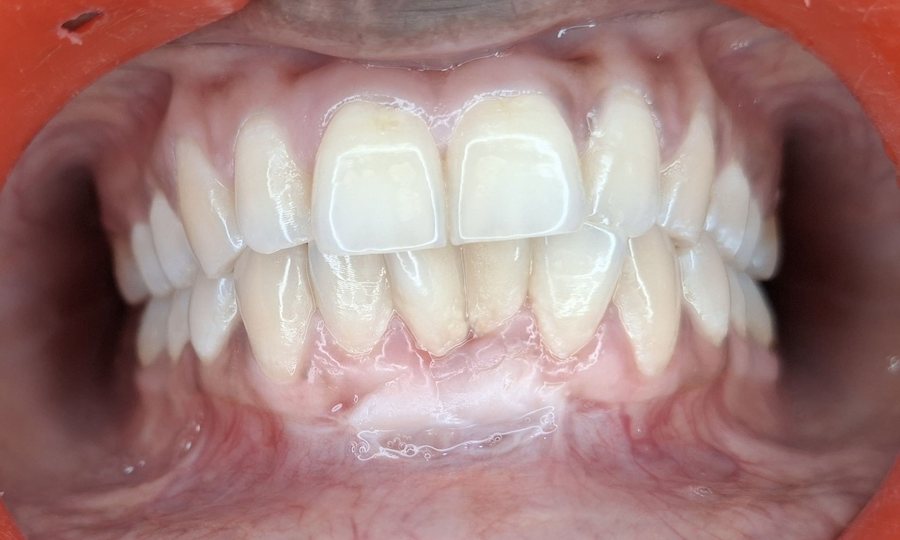 Gum Graft Surgery - After
