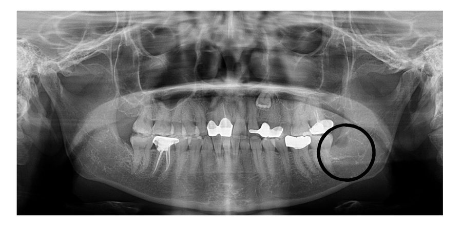 Wisdom Tooth Impaction - After