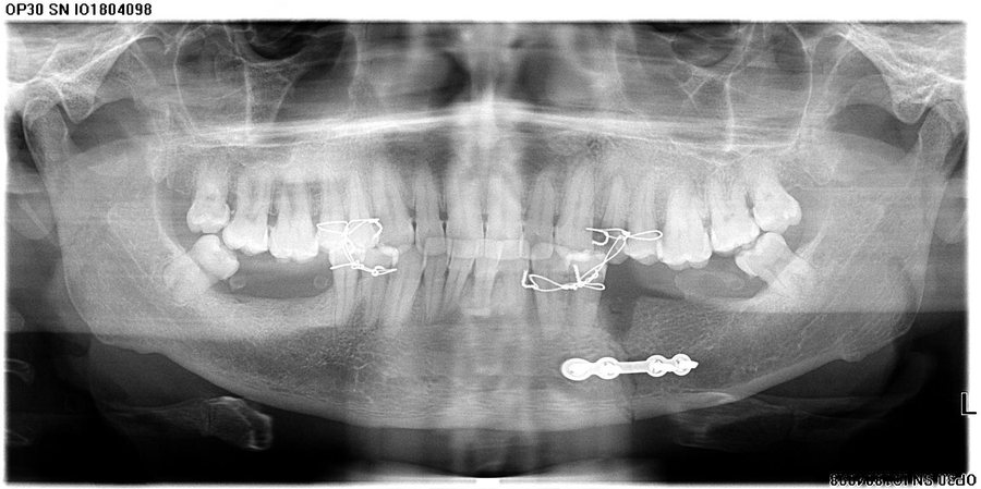 Fracture Management - After
