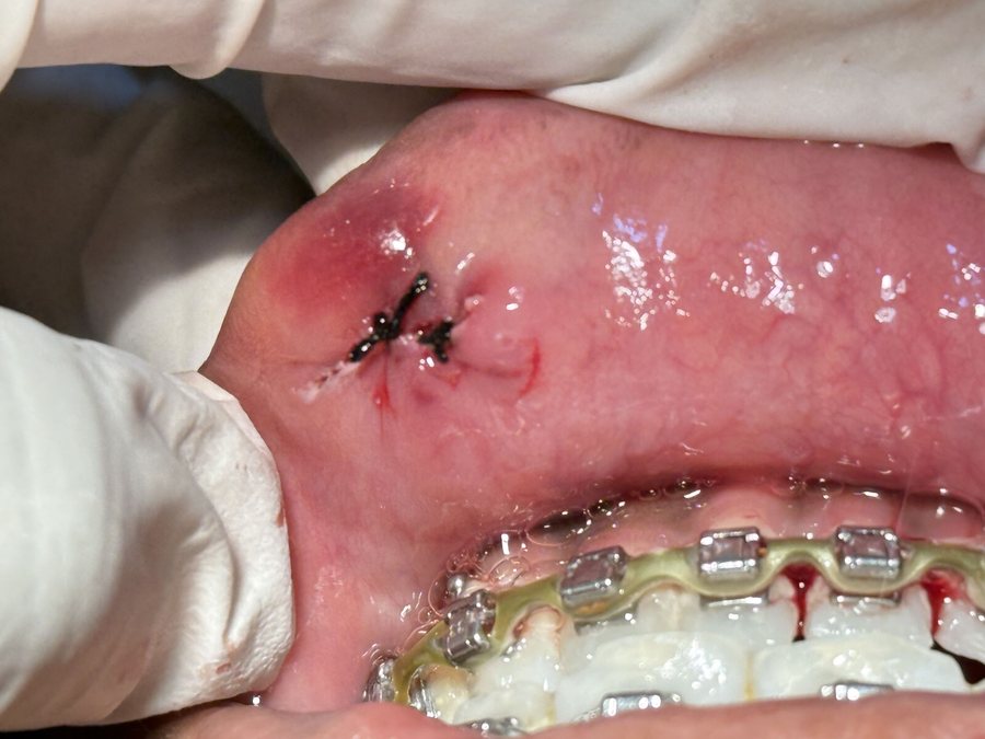 Minor Oral Surgery - After