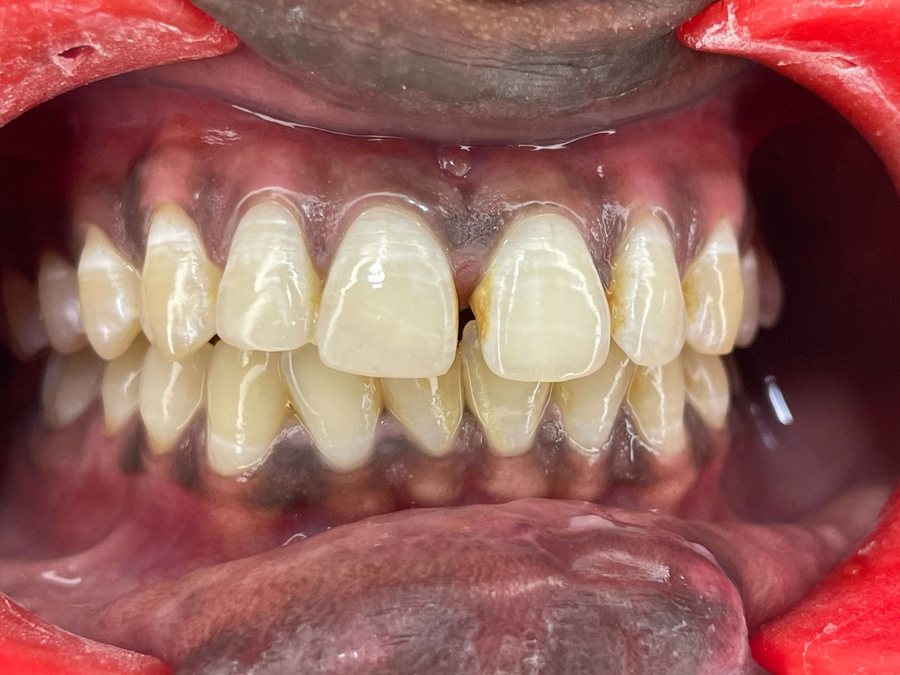Composite Restoration - After