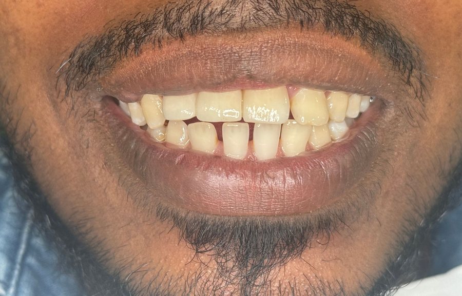 Fixed Dental Bridge - After