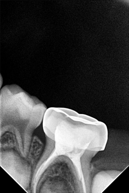 Paediatric Dental Treatment - After