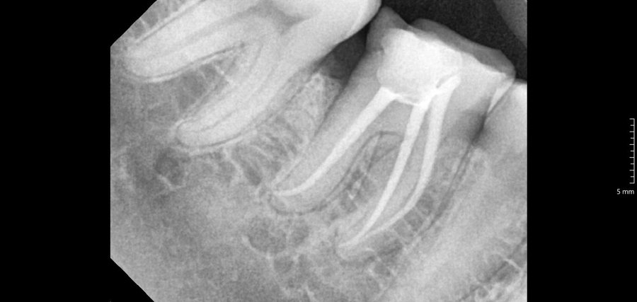 Root Canal Treatment - After