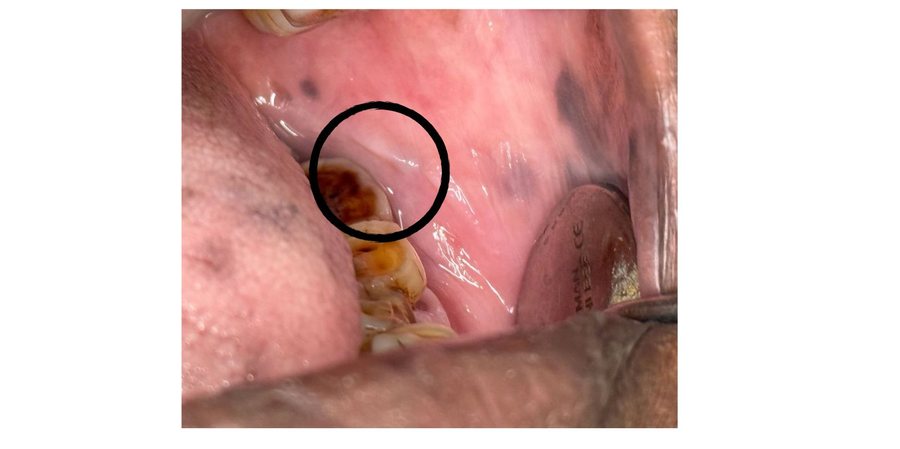 Ulcer Management - After