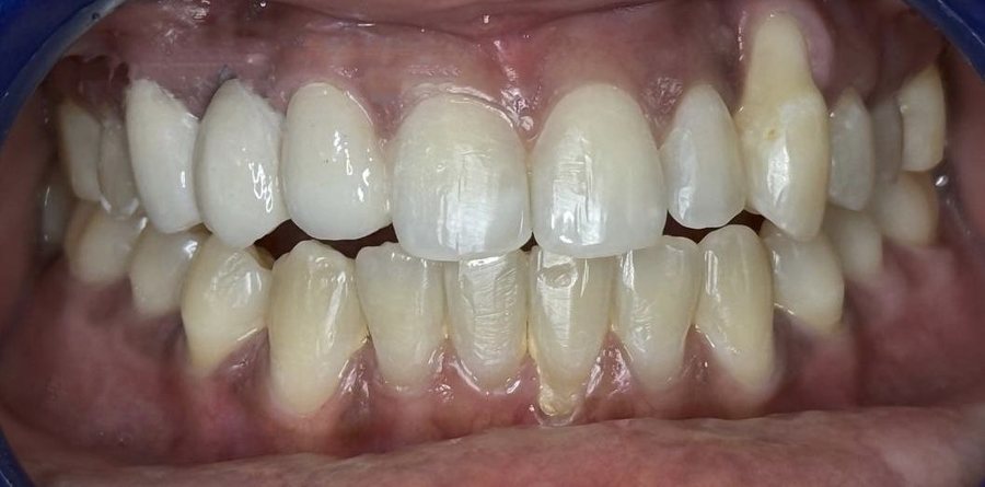 Clear Aligners – Open Bite - After