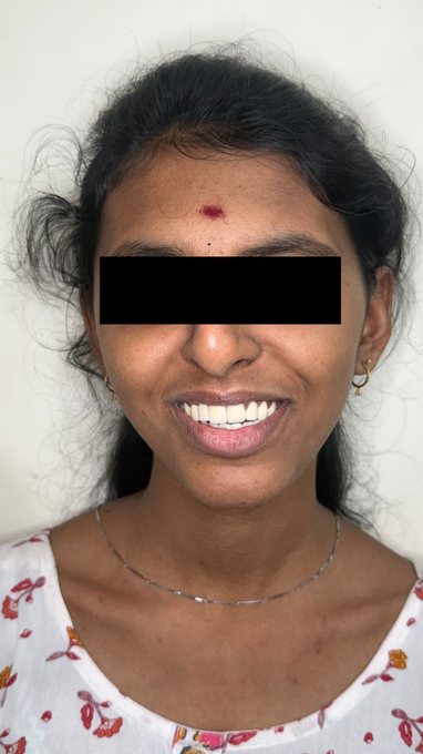Smile Transformation - After