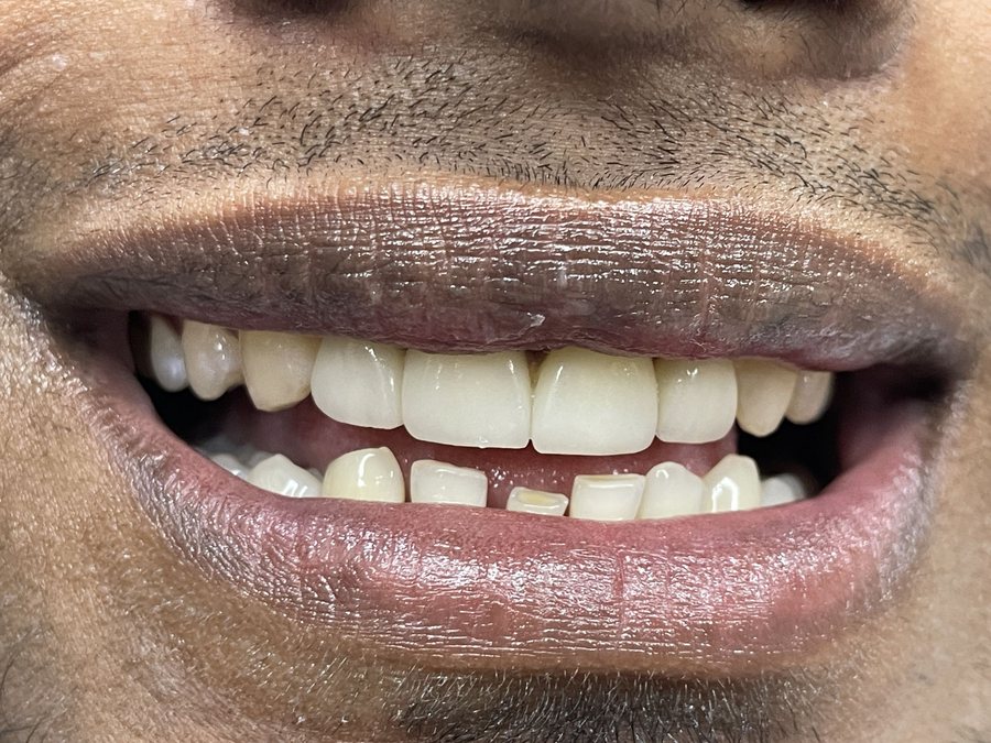 Smile Designing - After