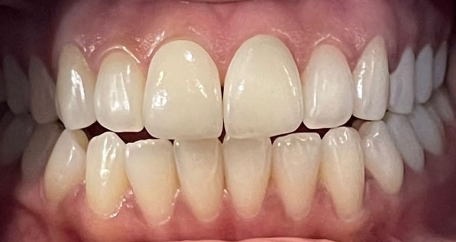 Ceramic Veneers - After