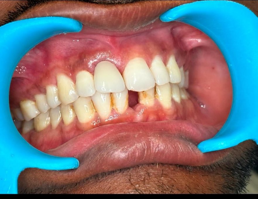 Single Dental Implant - After