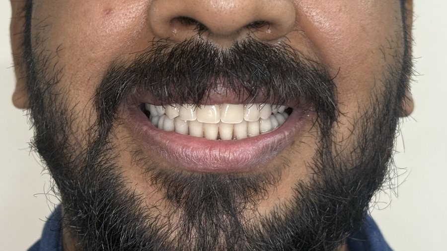 Implant Smile Makeover - After