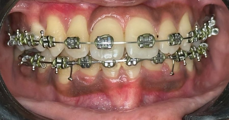 Orthodontic Braces - After