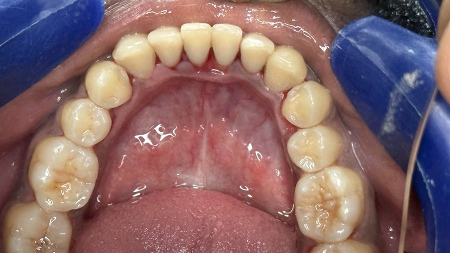 Scaling & Polishing - After