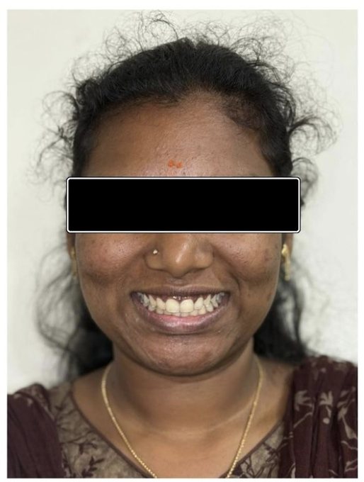 Clear Aligners – Spacing - After