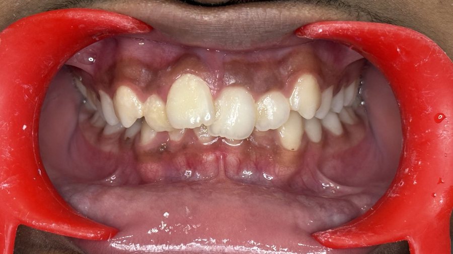 Clear Aligners – Crowding - Before
