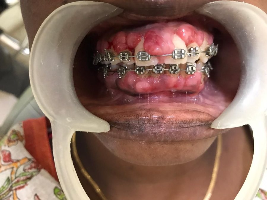 Gingival Enlargement - Before