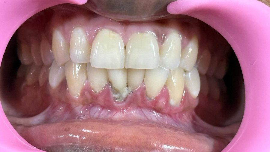 Gum Graft Surgery - Before