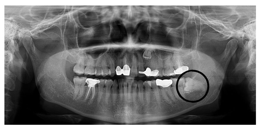 Wisdom Tooth Impaction - Before