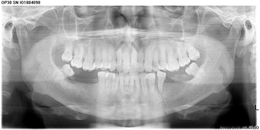 Fracture Management - Before