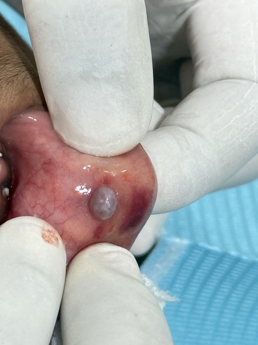 Minor Oral Surgery - Before
