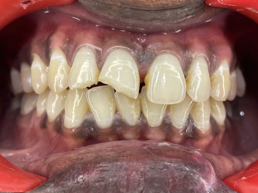 Composite Restoration - Before