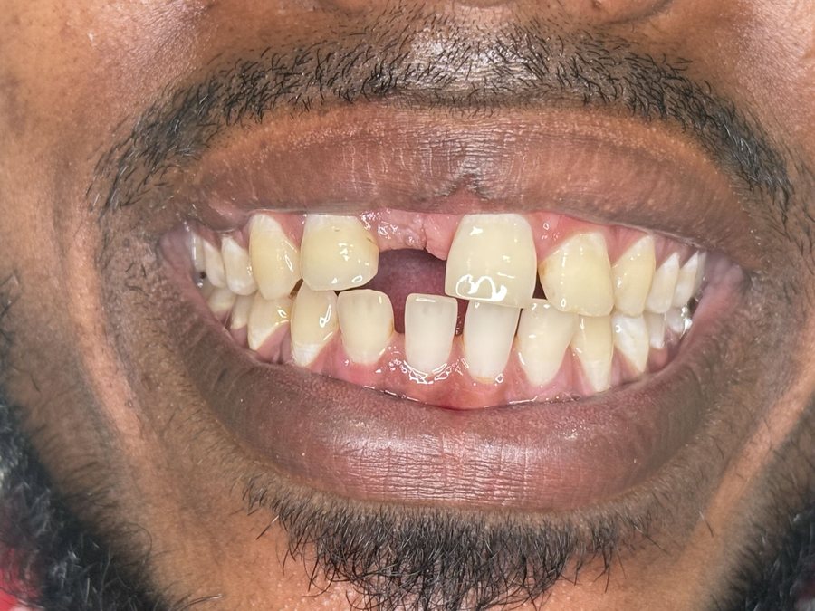 Fixed Dental Bridge - Before