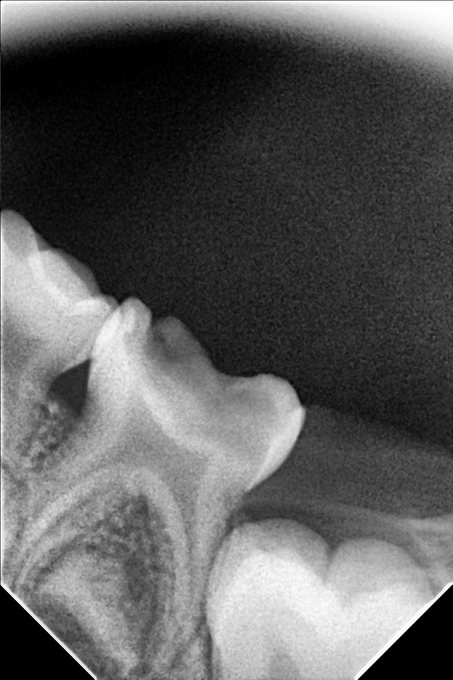 Paediatric Dental Treatment - Before