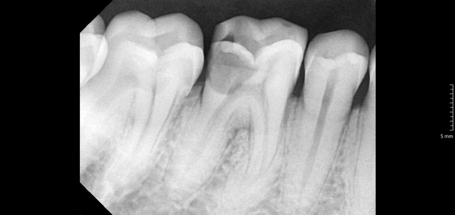 Root Canal Treatment - Before
