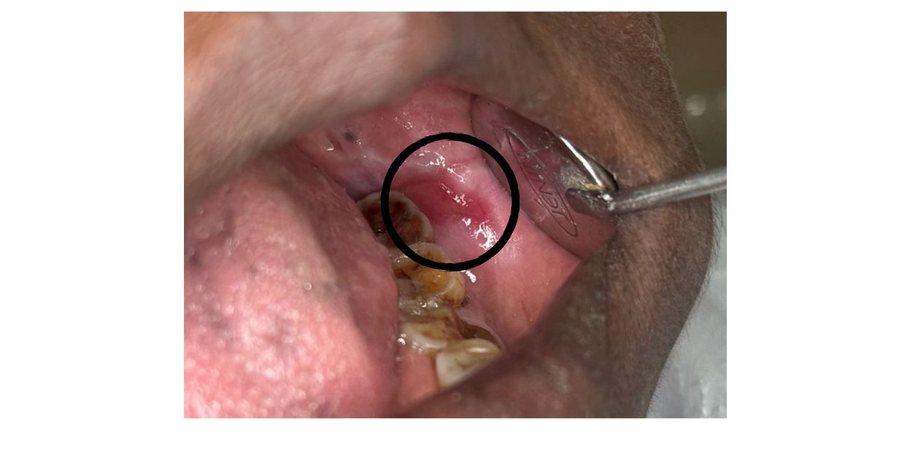 Ulcer Management - Before