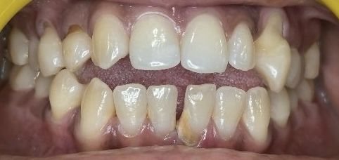 Clear Aligners – Open Bite - Before