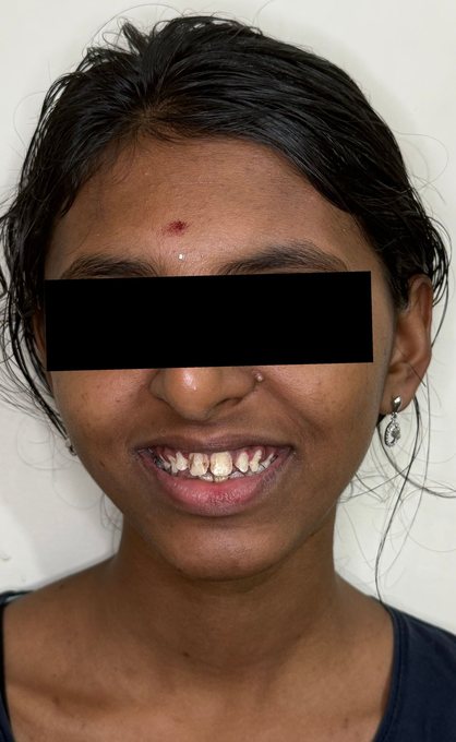 Smile Transformation - Before