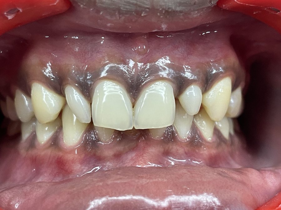 Smile Designing - Before