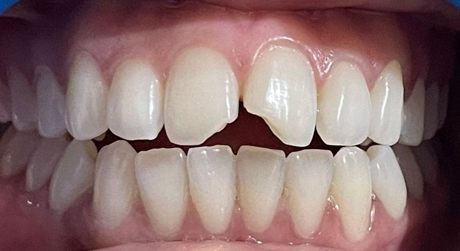 Ceramic Veneers - Before