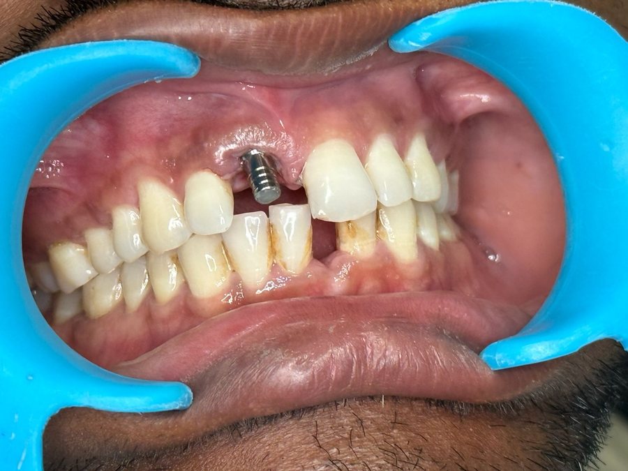 Single Dental Implant - Before