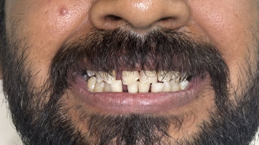 Implant Smile Makeover - Before