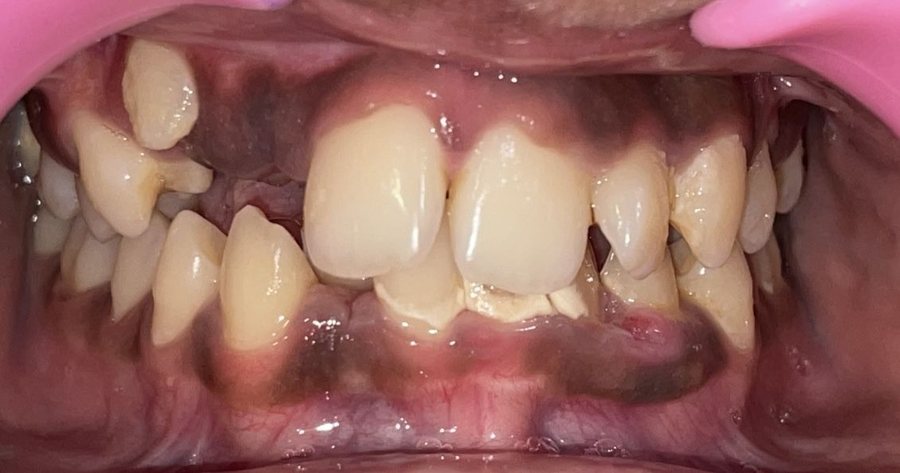 Orthodontic Braces - Before