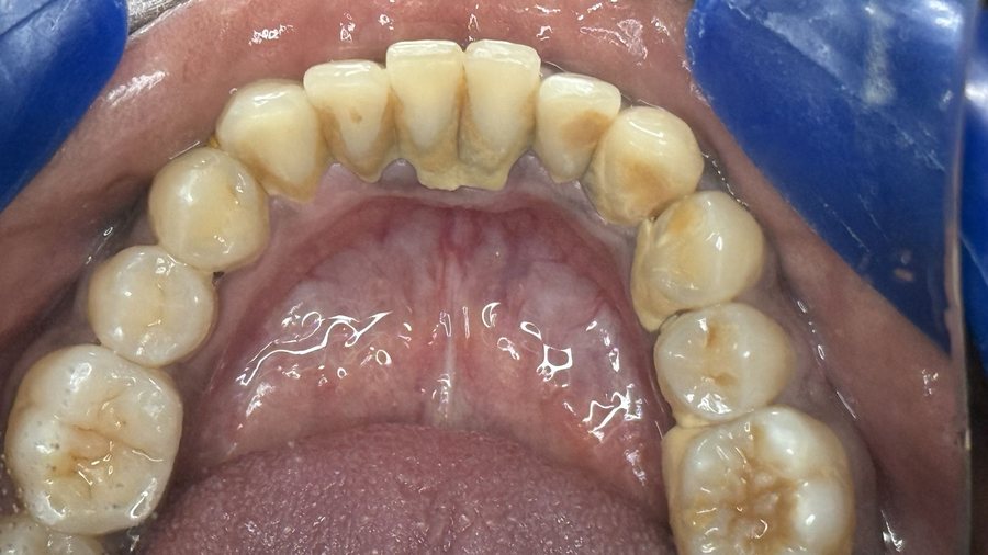 Scaling & Polishing - Before