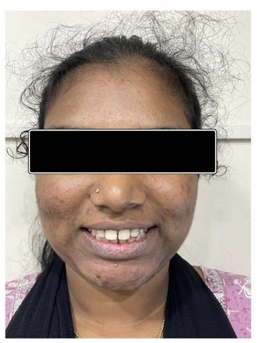 Clear Aligners – Spacing - Before