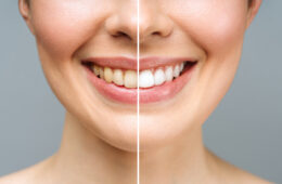 Dental Cleaning or Teeth Whitening: Which One Do You Actually Need?