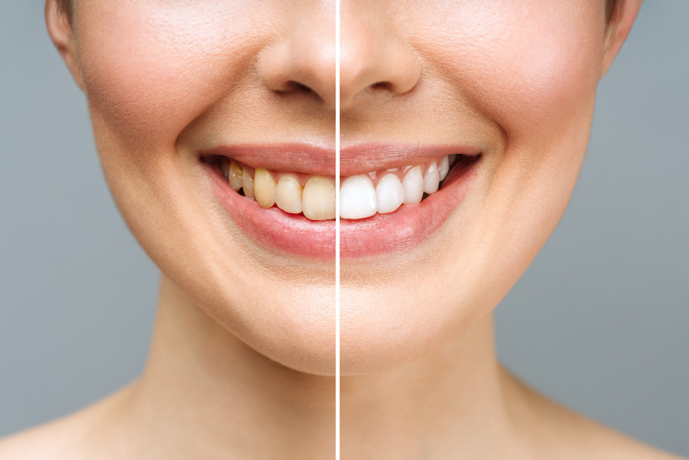 Dental Cleaning or Teeth Whitening