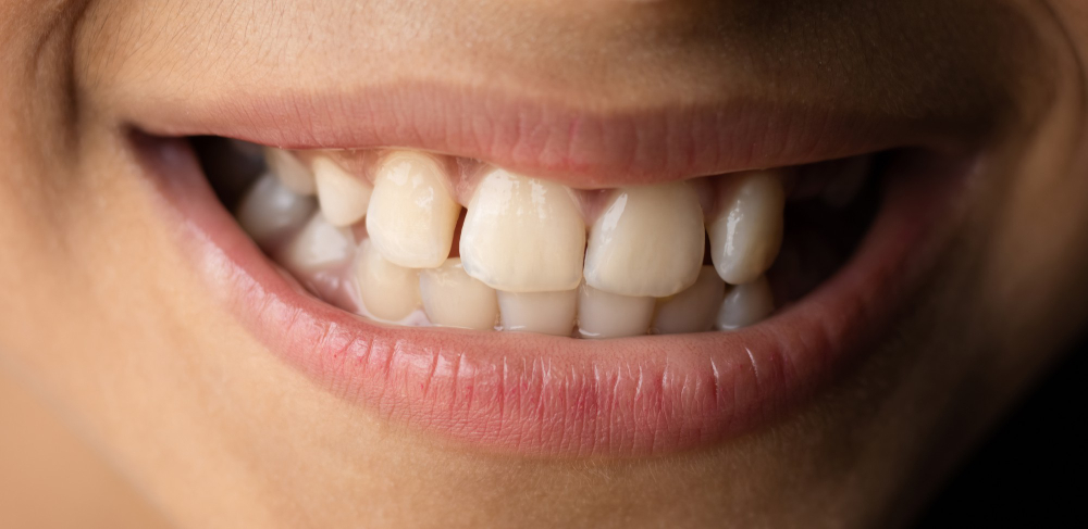 Missing One Tooth